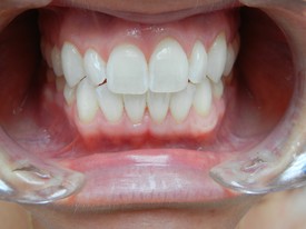beautiful white smile after teeth whitening in glendora ca